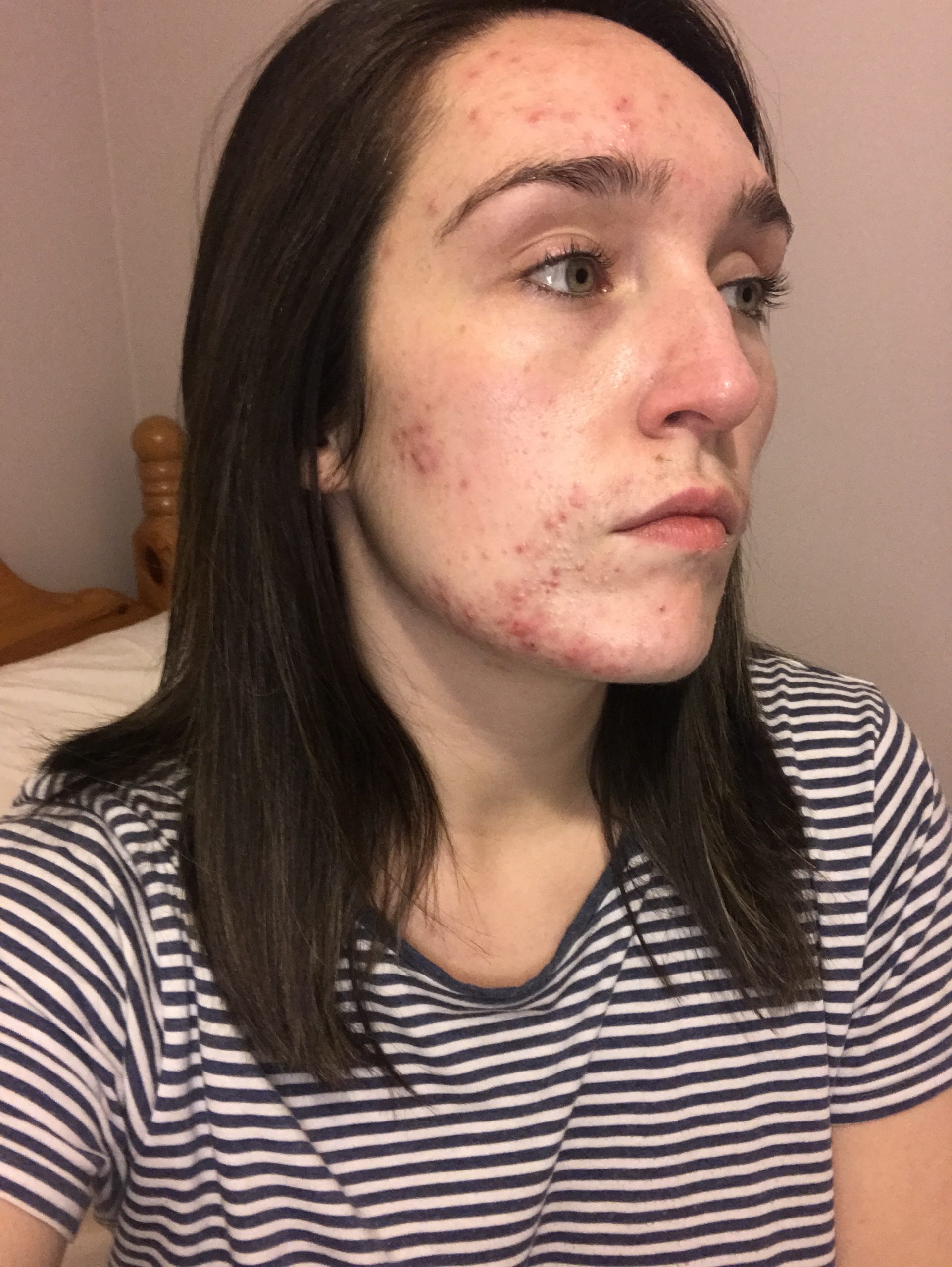 Adult Acne And How I Treat It Holy Chic Beauty Holy Chic